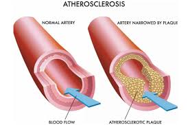 <p>Hardening of the arteries </p>