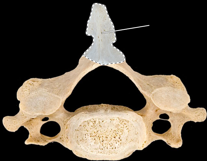 <p>What part of the vertebra is highlighted?</p><p>What type of vertebra is this (which region is this vertebra from)?</p><p>(Superior view).</p>