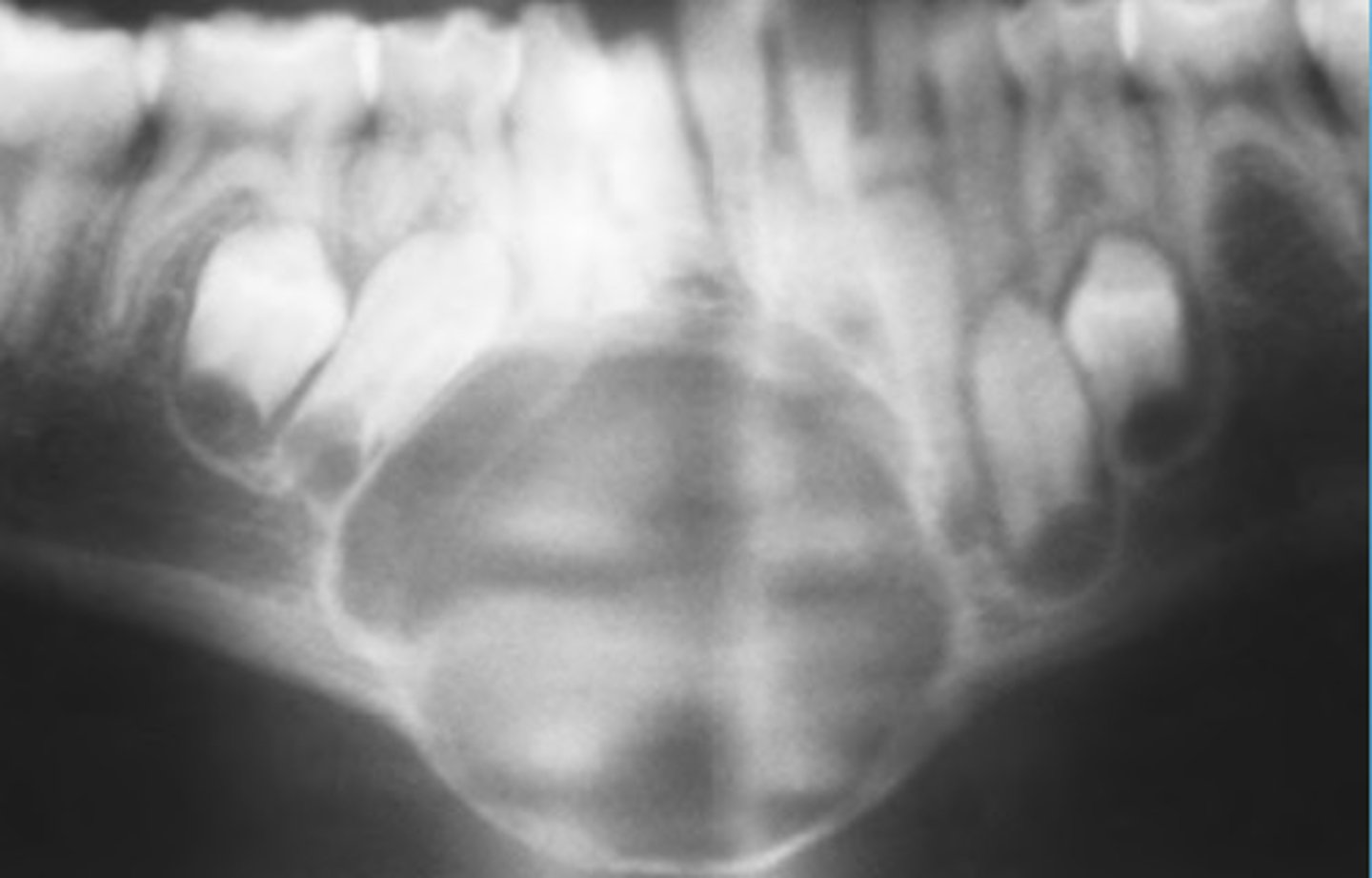 <p>what lesions can present as perfectly round corticated expansion?</p>