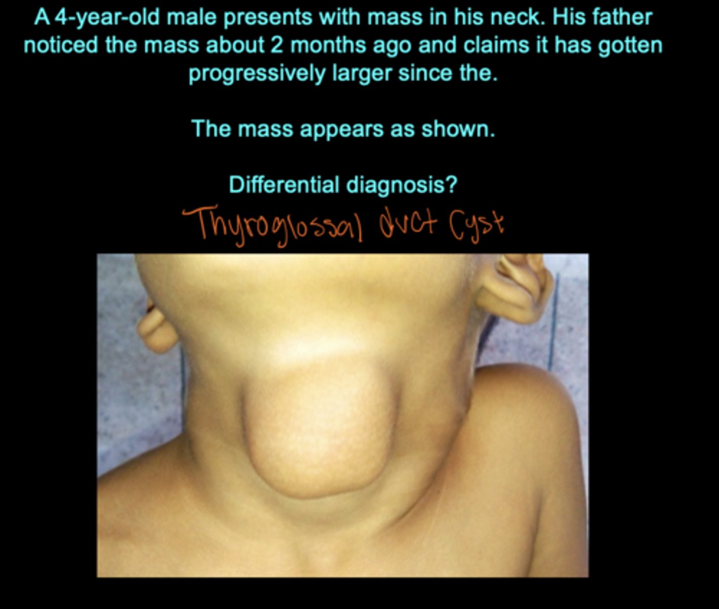 <p>Thyroglossal cysts or sinuses seen at the center of the neck/most anterior</p>