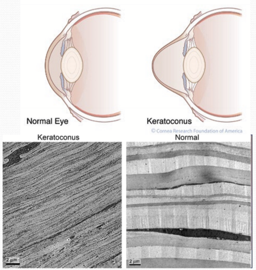 <p>A bilateral, progressive thinning and ectasia of the cornea that results in blurred vision from irregular astigmatism </p>