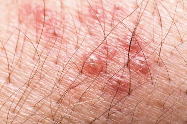 <p>what type of raised, fluid-filled, primary skin lesion is this?</p>