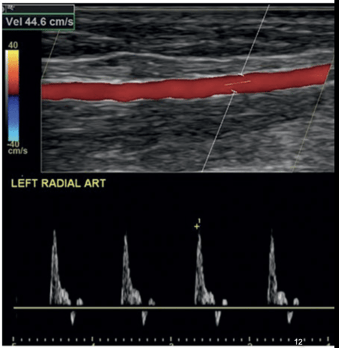 <p>Start with distal forearm of non-dominant arm</p><p>Assess for plaque, thickening, stenosis, compliance</p><p>Evaluate waveform &amp; note PSV - high resistant (rapid upstroke, sharp peak, low diastolic flow)</p>