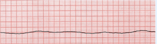 <p>what is asystole?</p>