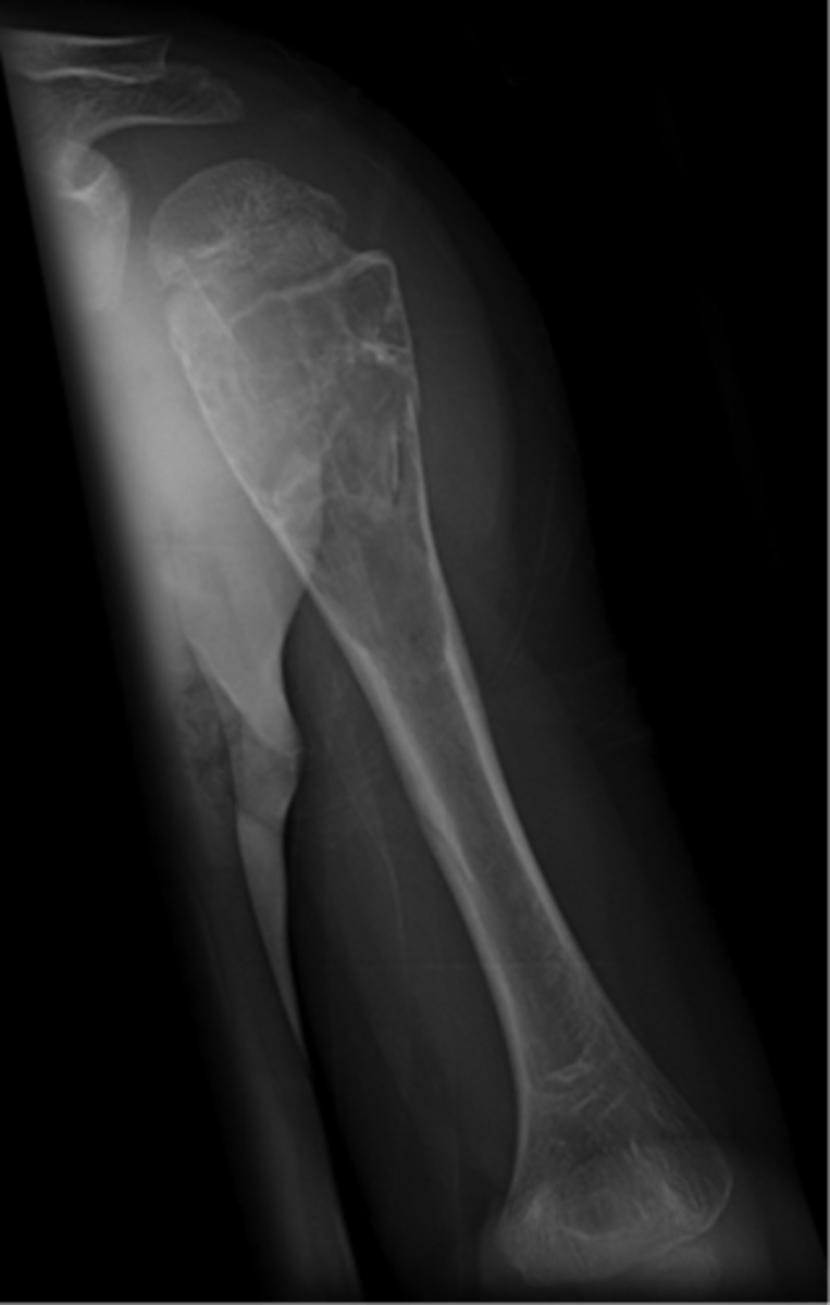 <p>- M:F, 2:1</p><p>- 3-14 y.o.</p><p>- Asymptomatic until fracture</p><p>- Proximal humerus (50%)</p><p>- Proximal femur (25%)</p><p>- Metaphyseal</p><p>- Migrate from physis with growth</p>