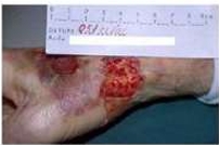 <ul><li><p>w/o tissue loss either linear or with a flap that closes the tear to within an approximation of 1mm of the wound edges</p></li></ul><p></p>