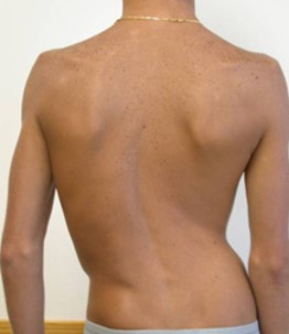 <p>Yes, scoliosis is a congenital condition.</p>