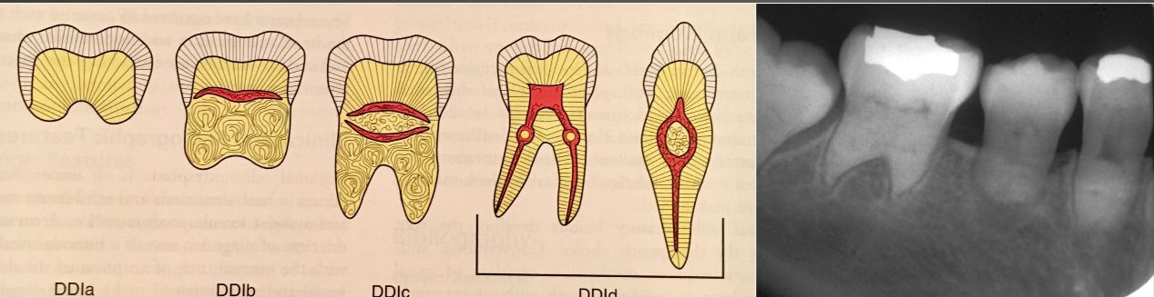 <ul><li><p> 4 types</p><ul><li><p>Normal clinical crown</p></li><li><p>Short roots</p></li><li><p>Periapical radiolucencies</p></li><li><p>Chevron pulp chambers</p></li></ul></li></ul><p>“ROOTLESS”</p>