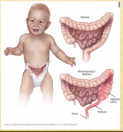 <p>massive dilation of bowel accompanied by abdominal distension and chronic constipation</p>