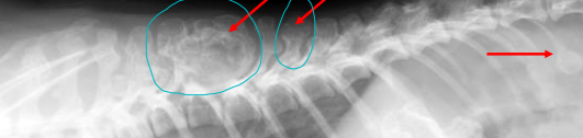 <p>Vertebral Tumors</p>