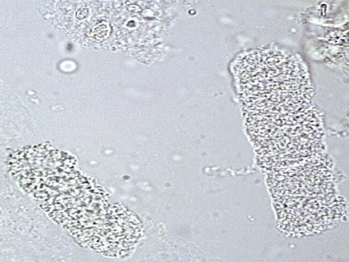 <p>Granular Cast</p><p>-From disintegration of cellular casts.</p>