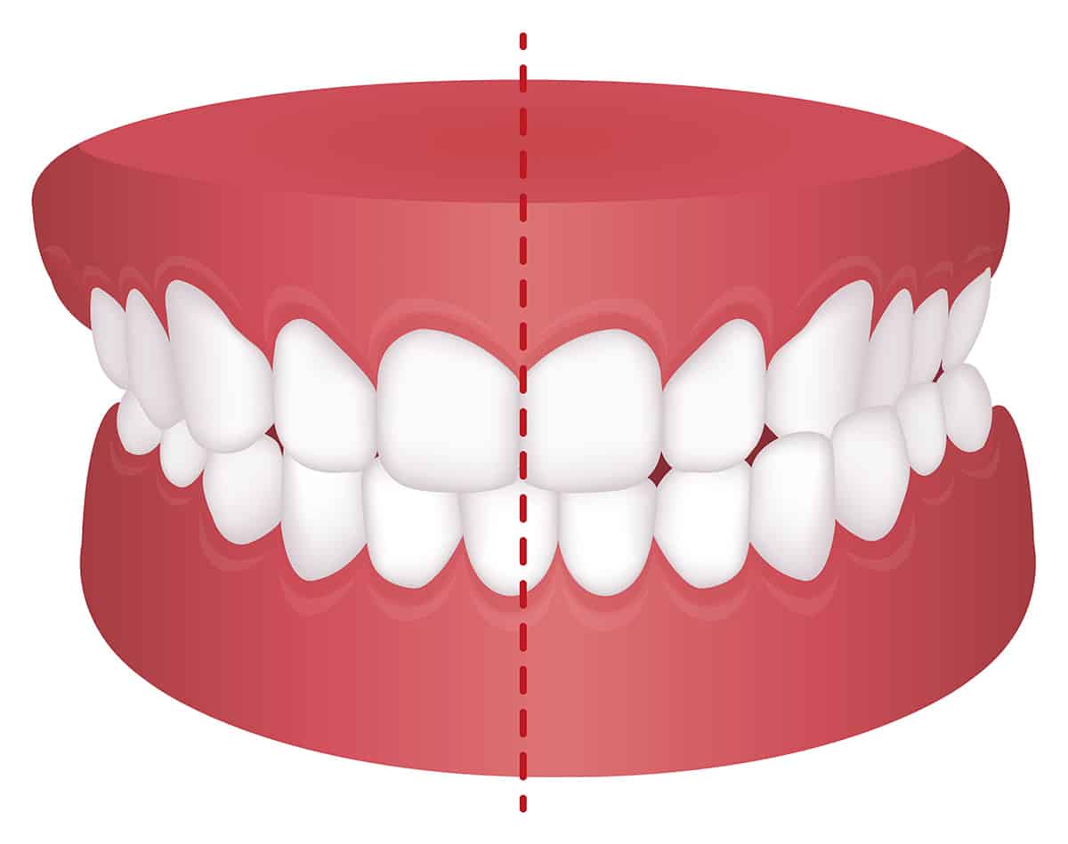 <p>cross-bite </p>