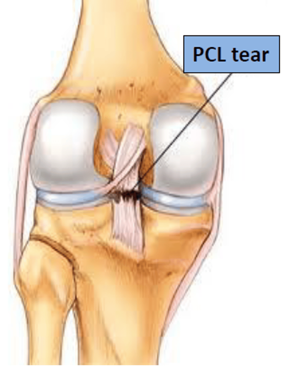 <p>Damaged by hyperextension or impacts to the upper end of the tibial tuberosity </p>
