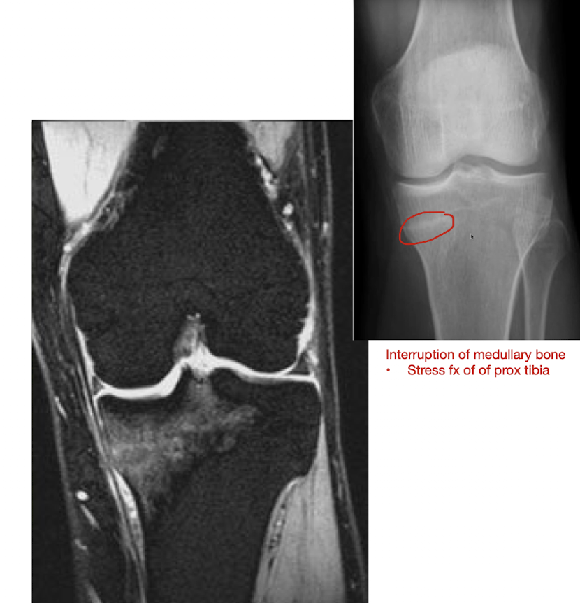 <p>Knee: Proximal Tibial Fx</p><ul><li><p>Where does this fx mostly occur?</p></li><li><p>How does this fx occur?</p></li><li><p>MOI?</p></li><li><p>__ Fx</p></li></ul><p></p><p></p>