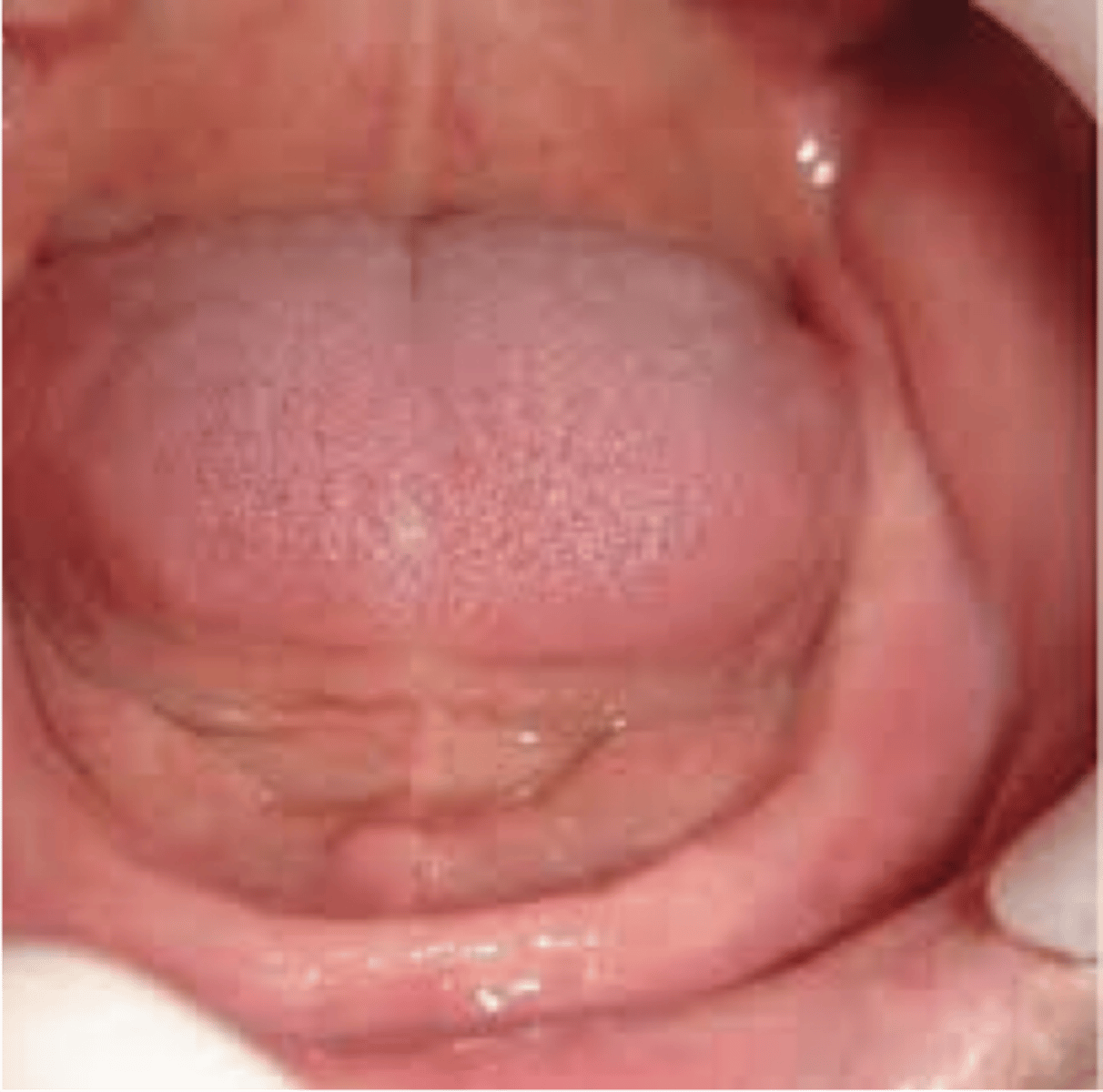 <p>tip of tongue doesn't touch incisors at all</p><p>retracted posteriorly</p><p>seen in less than 10%</p><p>frequent in edentulous adults</p>