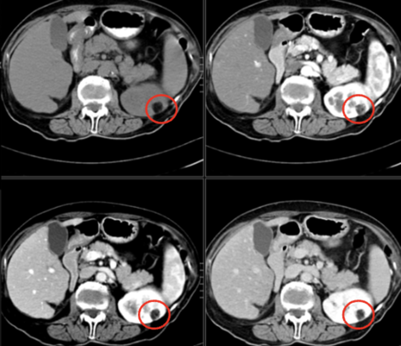 <p>Negro (densidad de grasa, similar a la grasa subcutánea).</p><p>NEGRO EN RM EN T1 Y T2</p><p>SE SUPRIME CON FAT SAT (EL TUMOR MALIGNO NO)</p>