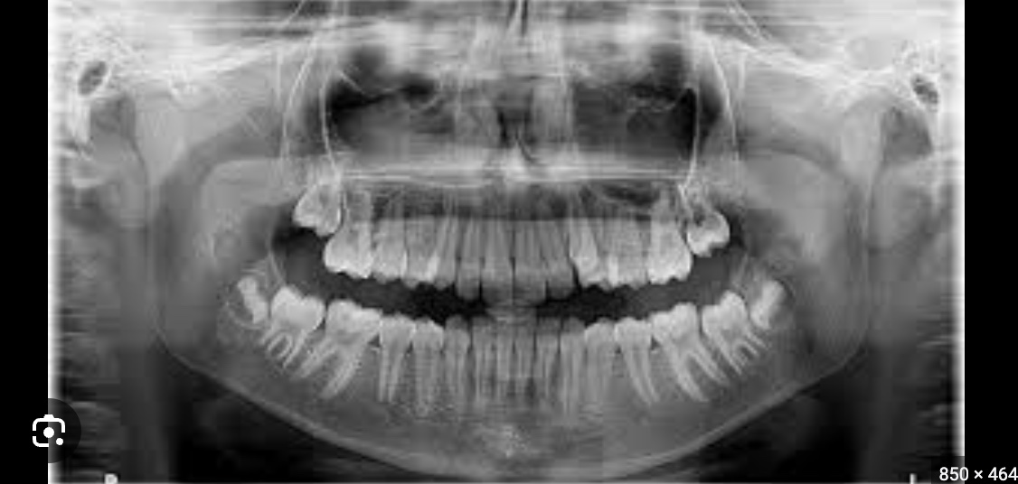 <p>what are panoramic xrays aka orthopantomogram?</p>