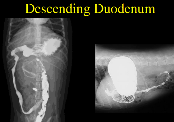 <p>Duodenum abnormalities  on Radiographs </p>