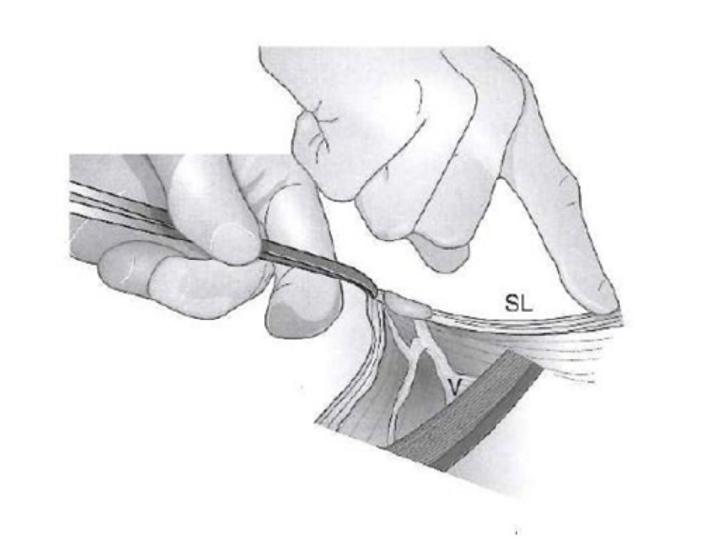 <p>which ovary is considered to be "tighter" when trying to break the suspensory ligament</p>