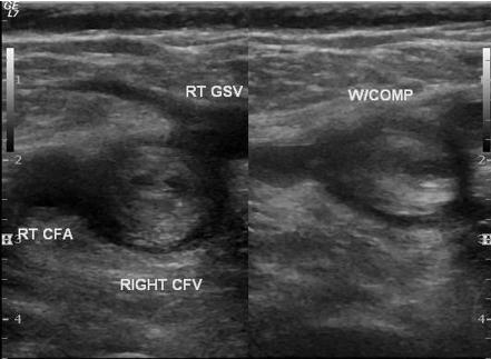 <p>Patient diagnosed with acute DVT. As scanning sonographer, you obtained this image. Select appropriate sonographic findings for acute thrombus.</p>
