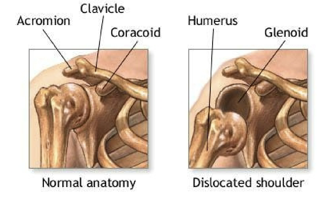 <ul><li><p>shoulder appears squared off</p></li><li><p>complete loss of function</p></li><li><p>previous history of dislocations</p></li></ul><p></p>