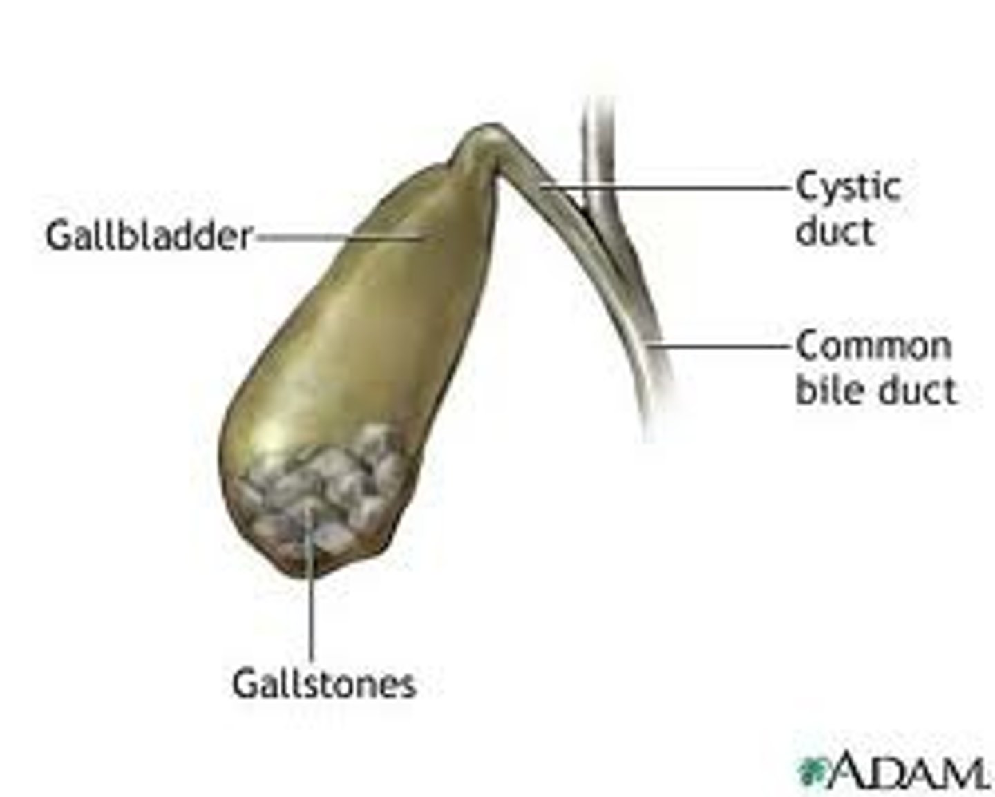 <p>aka cholelithiasis</p><p>an accumulation of hardened cholesterol/calcium deposits in the gallbladder</p><p>- can pass into GI tract or surgically removed</p>