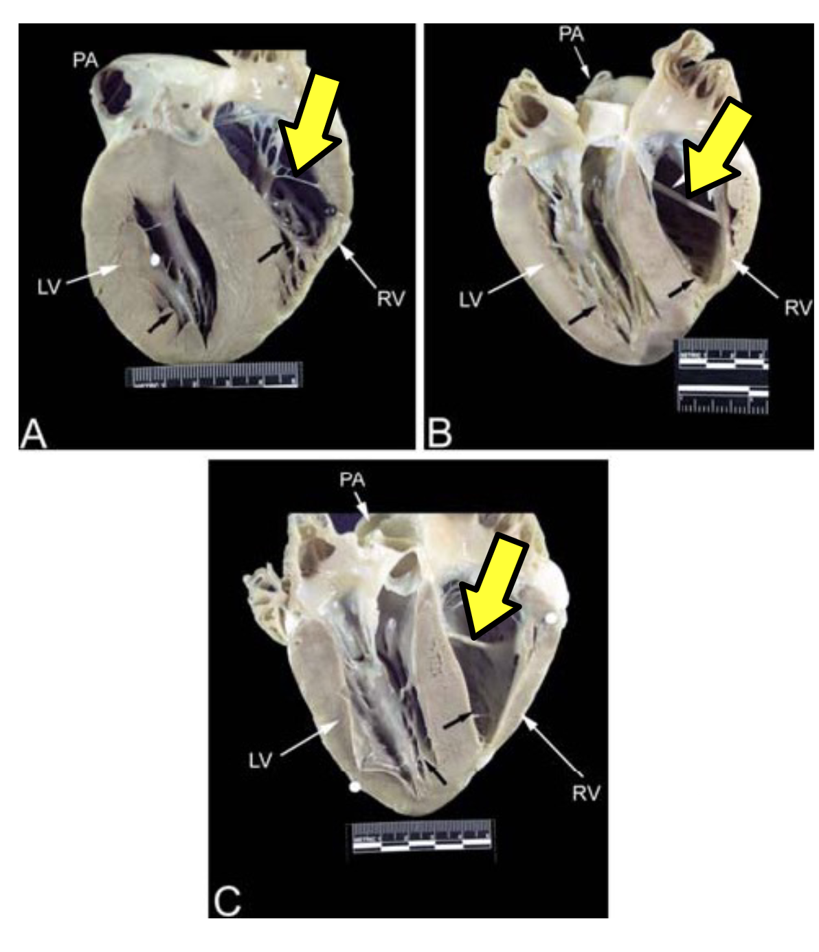 fibrous and muscular connection between interventriculuar septum and the right ventricular wall; carrier nerve (Purkinje) fibres