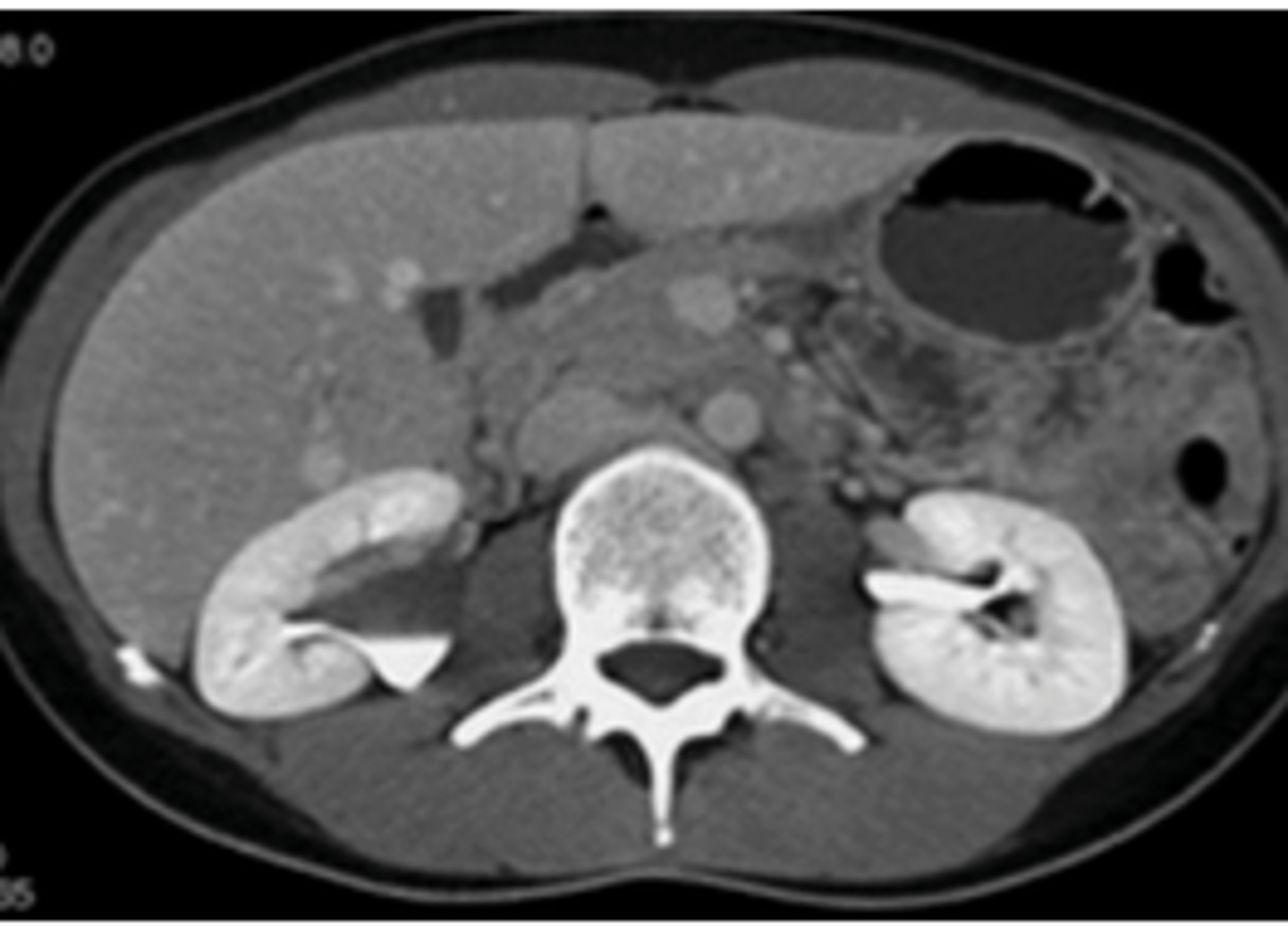 <p>contraste en las pelvis renales. Tarda 5 minutos</p>