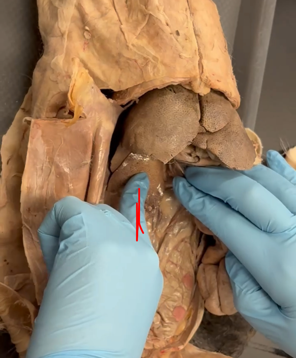 <p>Red finger is touching which lobe</p>