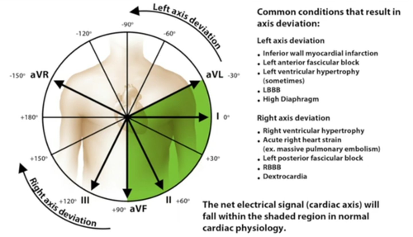 <p>Bottom right corner. Lead I and aVF are upright</p><p>→Because heart is tilted in that direction in the chest</p>