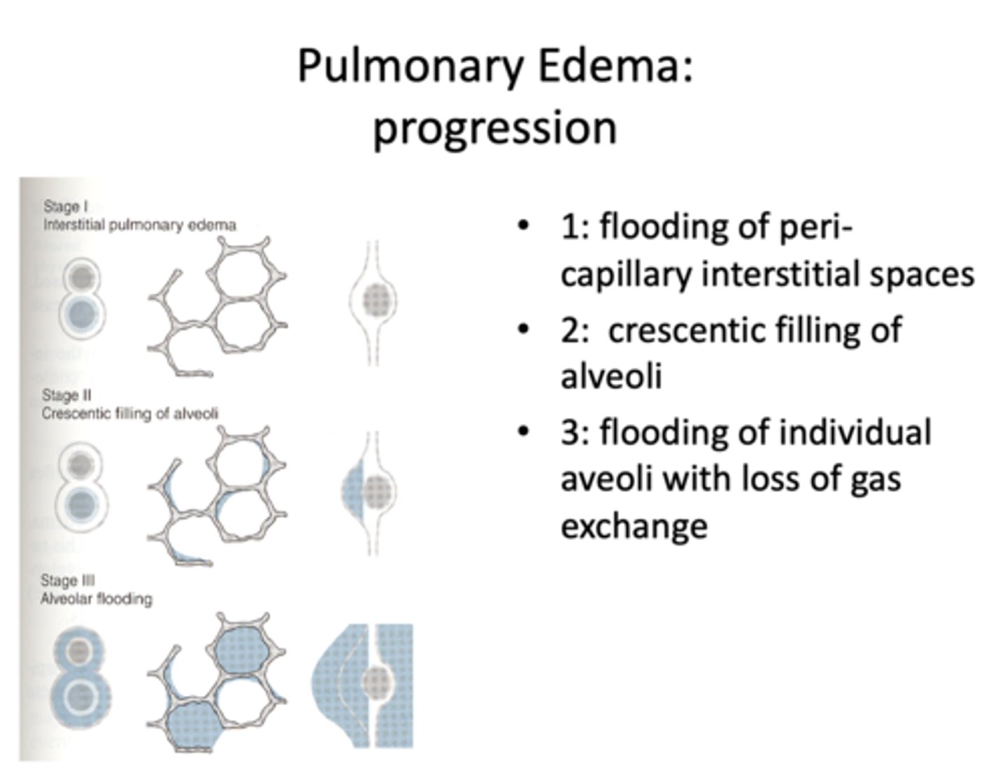 <p>Pulmonary edema</p>