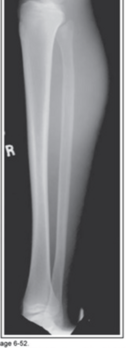 <p>Patella rolled towards IR (anterior rotation)</p>