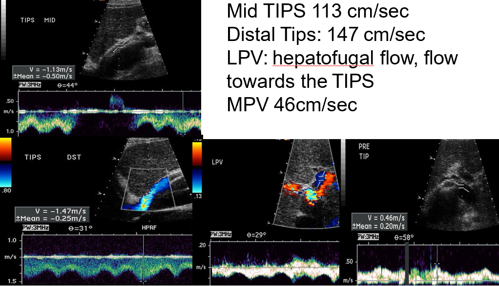 <p>successful or unsuccessful revision of TIPS? </p>