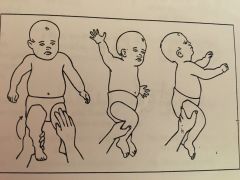 <ul><li><p><strong>stimulus: </strong>place infant in supine, flex one hip and knee toward the chest and hold briefly</p></li><li><p><strong>response: </strong>segmental rolling of upper trunk to maintain alignment</p></li><li><p><strong>fxn sig:</strong></p><ul><li><p>promotes trunk and spinal rotation to facilitate sitting and quadruped positions</p></li></ul></li><li><p><strong>onset age: </strong>4-6mos</p></li><li><p><strong>integration: </strong>5yrs</p></li></ul><p></p>