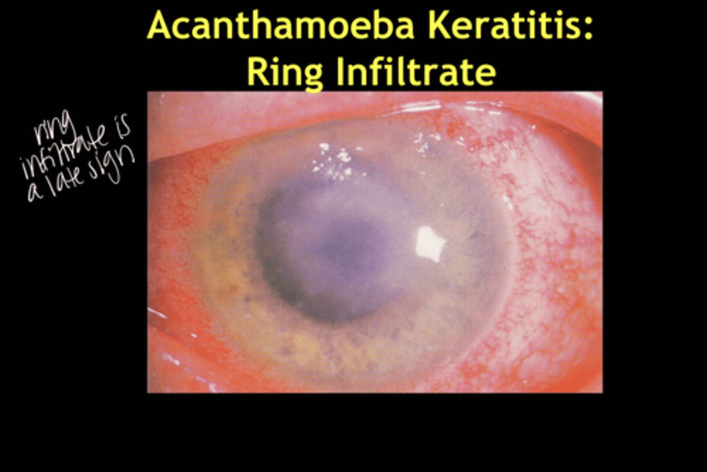 <p>Acanthamoeba Keratitis -- Early Ring Infiltrate (Pic)</p>