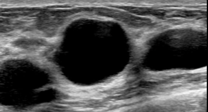 <p>Breast cysts</p>
