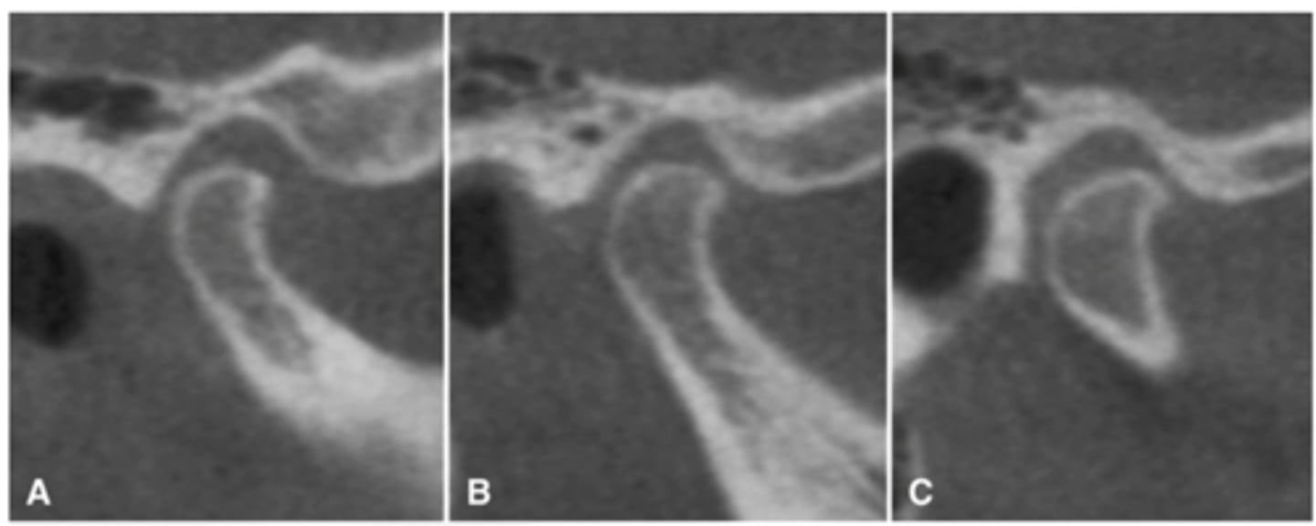 <p>Joint positions can vary from lateral to medial pole as seen in the radiograph so to determine if the condyle is eccentrically located or centered just see where the condyle is sitting most of the time. Would the example be eccentrically located or centered?</p>