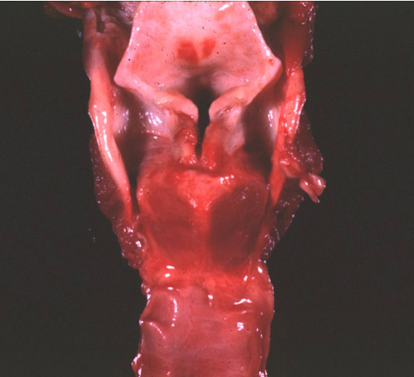 <p>In this case of equine laryngeal hemiplasia, incomplete abduction of _____________ results in stridor. Denervation causes atrophy of the _____________________.</p>