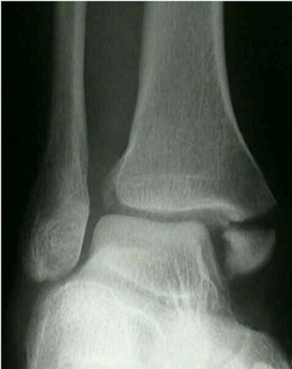 <p>A 37 year old man was in a motorcycle accident and you are examining his injured ankle. You see his x-ray below.</p><p>What fracture do you see?</p>