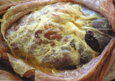 <p>Fibrinosuppurative polyserositis on multiple <strong>serosal surfaces</strong></p>