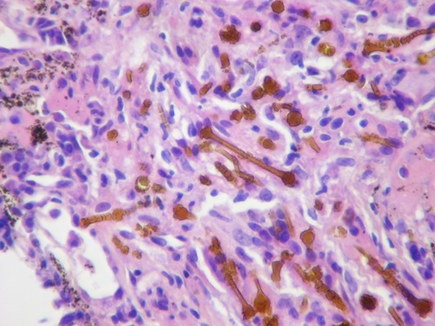 <p>A scarring of the lungs</p>