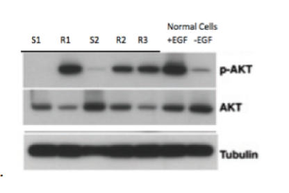 <p><strong>AKT is transcription factor that is phosphorylated by Erk (a MAPK) when the EPF (epidermal growth factor) pathway is activated. Proteins were extracted from normal cells that were either untreated (-EGF) or treated (+EGF) with EGF. Proteins were also extracted from 5 patient tumours (labelled S1, S2, R1, R2, R3), which have the ras mutation, but also have been treated with a ras inhibitor.</strong><span><strong>&nbsp; </strong></span><strong>Proteins were run on a SDS PAGE and then western blotted with 3 different antibodies- one recognizes AKT, one recognizes the phosphorylated form of EGF (pEGF) and one that recognizes tubulin.</strong><span><strong>&nbsp;</strong></span></p><p></p><p><span>(i)</span><span style="font-size: 7pt; font-family: &quot;Times New Roman&quot;">&nbsp;&nbsp;&nbsp;&nbsp;&nbsp;&nbsp;&nbsp;&nbsp;&nbsp; </span><strong>From looking at this Western blot how can you tell if the pathway is active or not?</strong></p><p></p><p><span>(ii)</span><span style="font-size: 7pt; font-family: &quot;Times New Roman&quot;">&nbsp;&nbsp;&nbsp;&nbsp;&nbsp;&nbsp;&nbsp;&nbsp;&nbsp; </span><strong>What does this experiment tell you about the EGF pathway in the different tumours, and for which ones is the ras inhibitor a possible treatment?</strong></p>