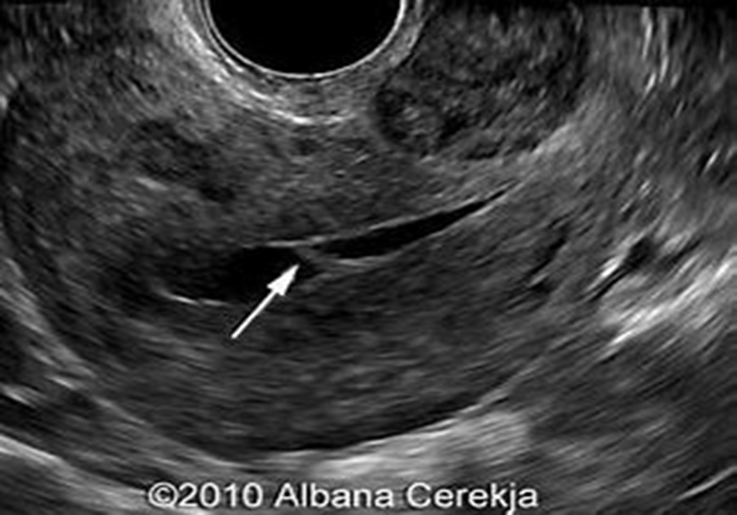 <ul><li><p>results from </p><ul><li><p>trauma</p></li><li><p>surgery</p></li><li><p>D&amp;C</p></li><li><p>C-section</p></li><li><p>Postpartum curettage </p></li></ul></li></ul><p></p>