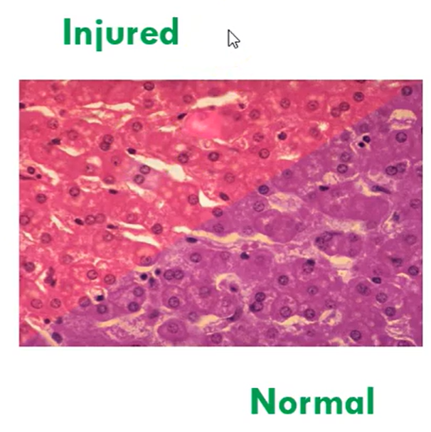 <ul><li><p>ribosomes, granular/rough endoplasmic reticulum damaged</p></li><li><p>protein synthesis stops</p></li><li><p>cytoplasm stains more eosinophilic (ie. more pink)</p></li><li><p>reversible</p></li></ul><p></p>