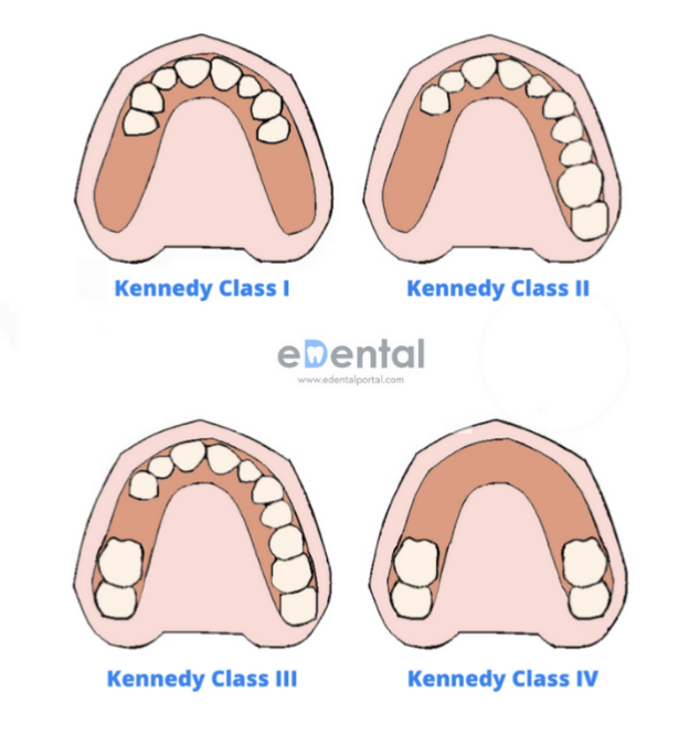 <ul><li><p><strong>Classe I :</strong> perte du calage postérieur bilatéral, surcharge des dents résiduelles, migrations dentaires, modification de la DV</p></li><li><p><strong>Classe II :</strong> perte du calage postérieur unilatéral, surcharge des dents résiduelles, migrations dentaires, modification de la DV</p></li><li><p><strong>Classe III :</strong> migration dents adjacents, égression dents antagonistes, perte des points de contact, pathologie parodontale concomitante&nbsp;</p></li><li><p><strong>Classe IV :</strong> migration des dents adjacentes, égression des dents antagonistes, perte des points de contact, pathologie parodontale concomitante, implication esthétique, perturbation du guide antérieur&nbsp;</p></li></ul><p></p>