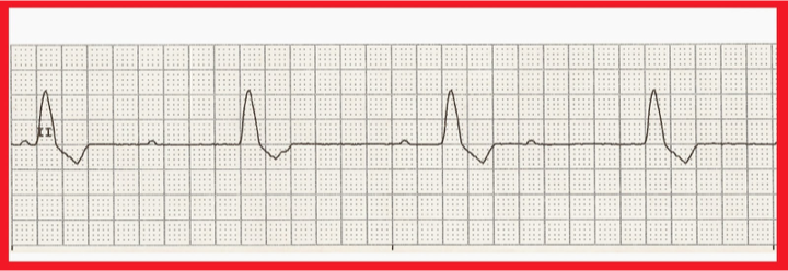 <p>What does this refer to</p><ul><li><p>No conduction is taking place through the AV node. </p></li><li><p>Typically, atrial and ventricular depolarizations take place at their intrinsic firing rates with no relation to one another.</p></li><li><p>P waves are not associated with QRS—cardiac output insufficient</p></li></ul><p></p>