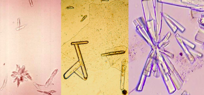 <p>Normal</p><ul><li><p>alkaline urine</p></li><li><p>Soluble in acetic acid</p></li><li><p>rosette can be confused with sulfonamide (sulfonamide wont dissolve in acid)</p></li><li><p>Sometimes in kidney stones</p><p></p></li></ul><p></p>