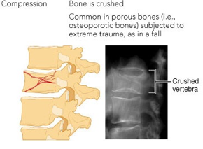 <p>bone is crushed</p><ul><li><p>vertebral and knee bone are mostly affected </p></li></ul>