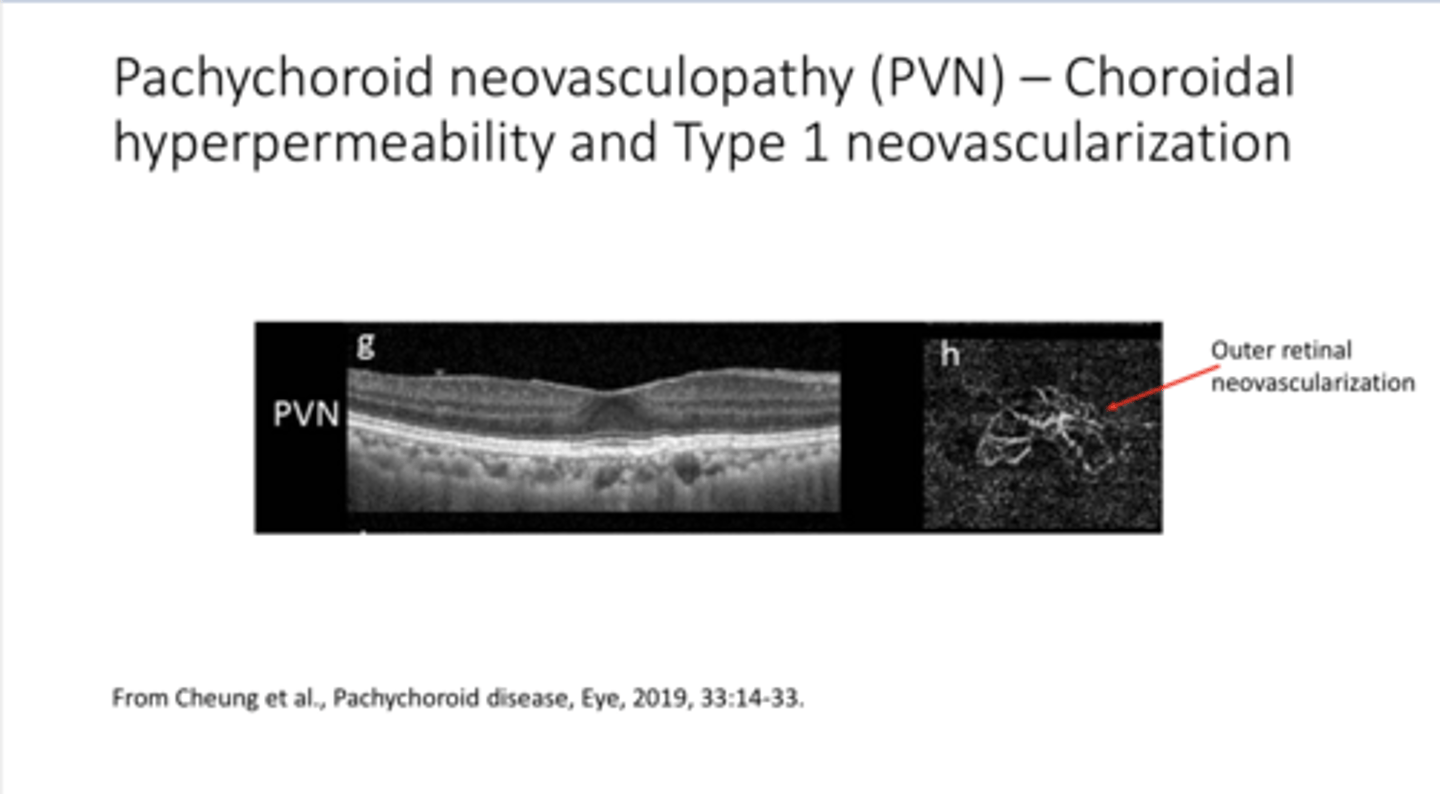 <p>What is present in the outer retina of Pachychoroidal Neovasculopathy (PVN)?</p>