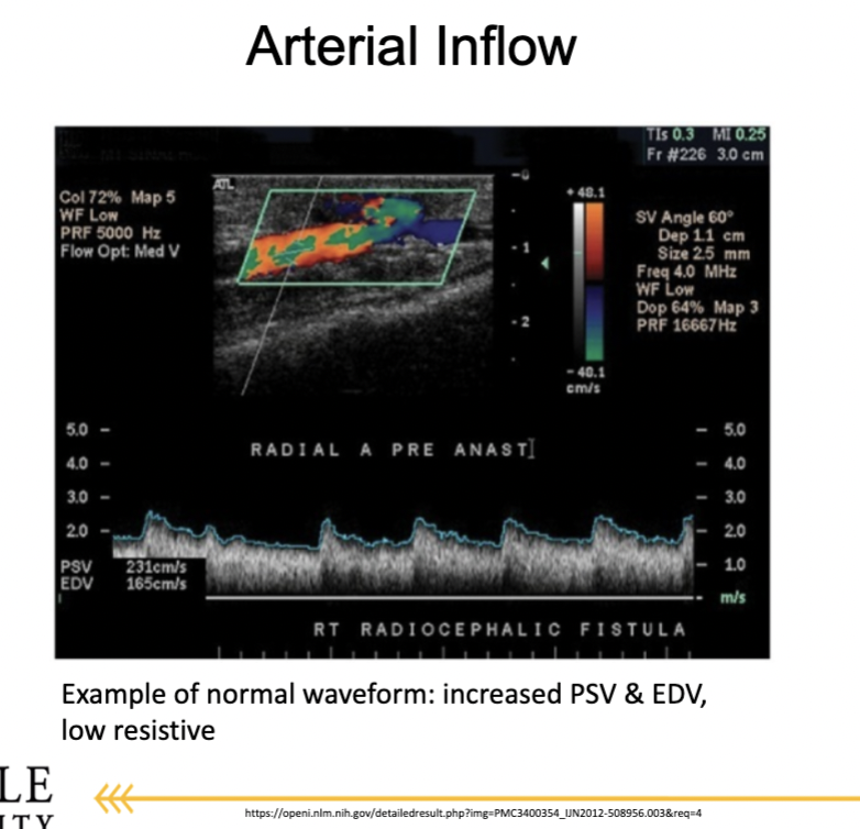 <p>What are normal and abnormal arterial waveform findings near a dialysis access?</p>